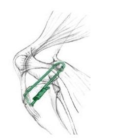 Extracapsular ACL Surgery
